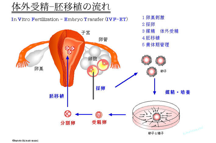 図Ⅰ　体外受精―胚移植の流れ.JPG