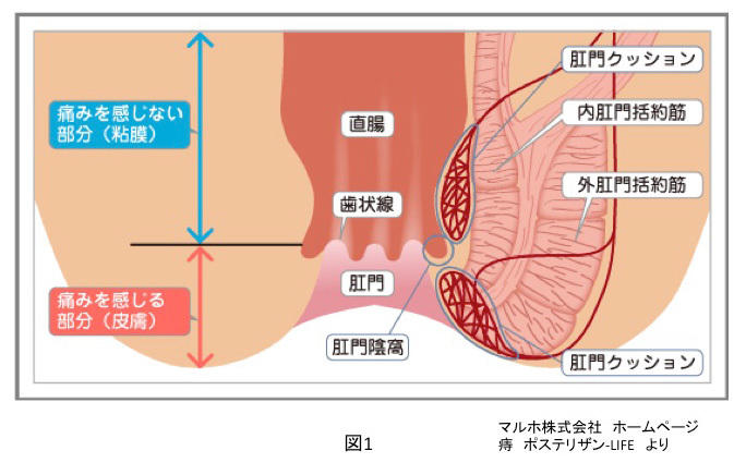 おしり の あな でき もの 痛く ない