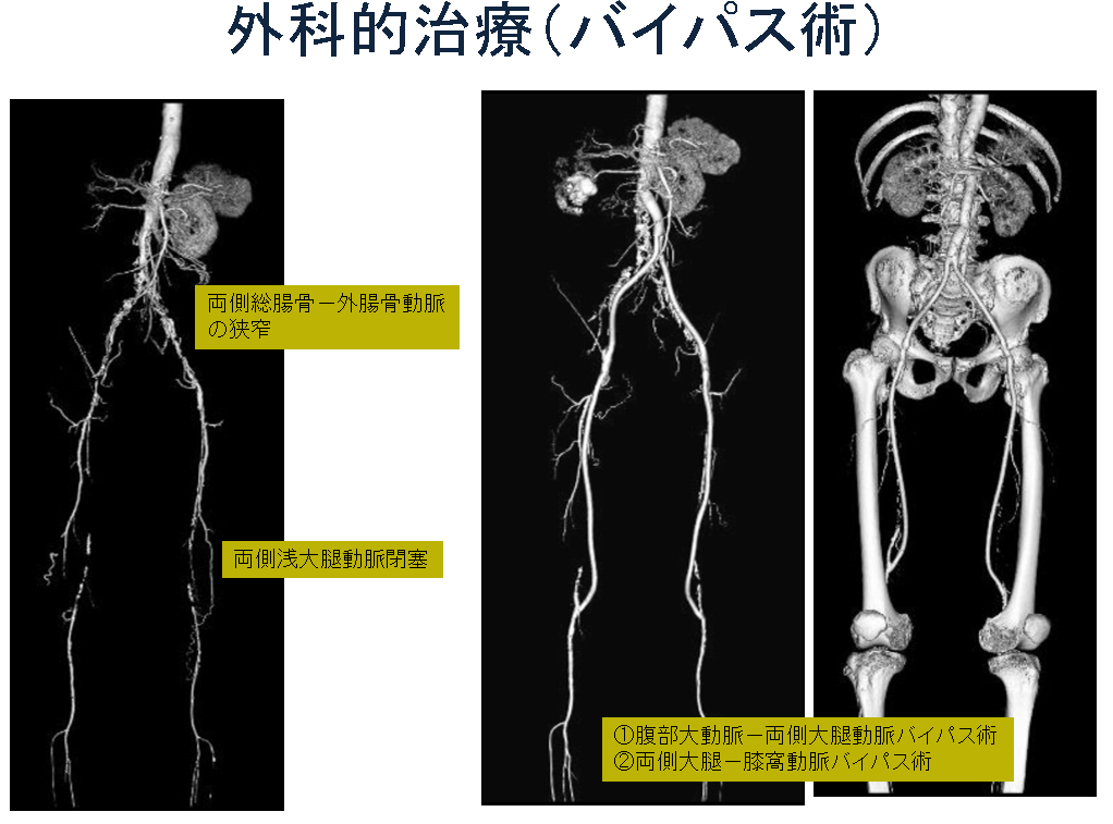 下肢閉塞性動脈硬化症(ASO)の治療 下肢間歇性跛行 足の潰瘍・壊疽・下肢血行障害でお困りの患者さまへ 山形済生病院 社会福祉法人 恩賜財団 済生会