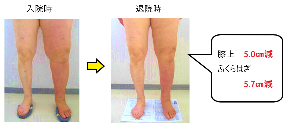 足 の 甲 リンパ 浮腫