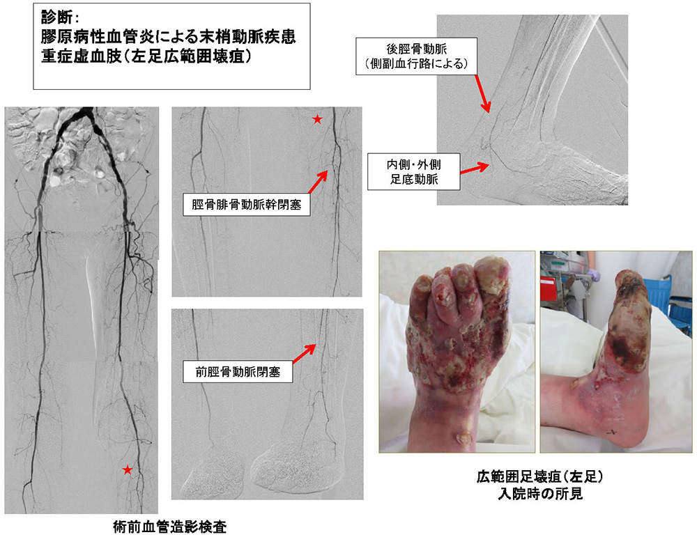 壊死 左足 左足壊死ニキの画像2014～2015を検証し、よくいる駅を分析した結果！2つの駅に絞られた