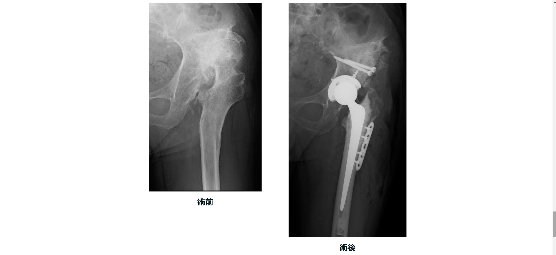 人工股関節置換術が必要なのは誰ですか?