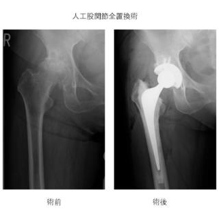 1 「股関節（こかんせつ）の話」 | 健康コラム | 山形済生病院 | 社会