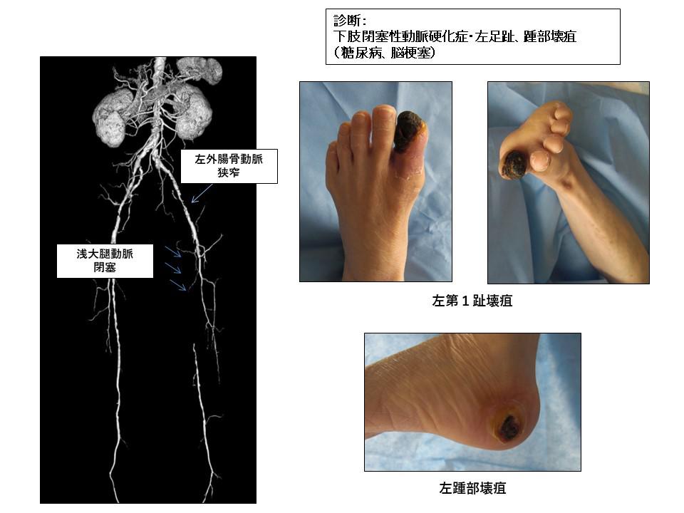 足 の 壊疽 治療