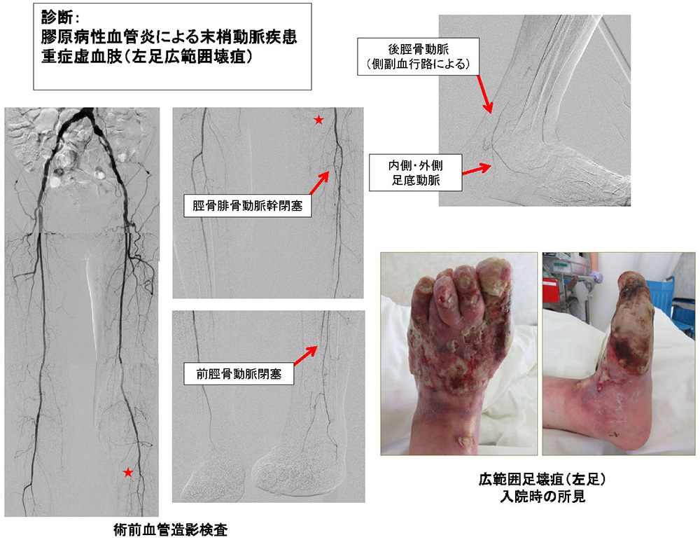 糖尿病性足潰瘍の100例 裁断済み-